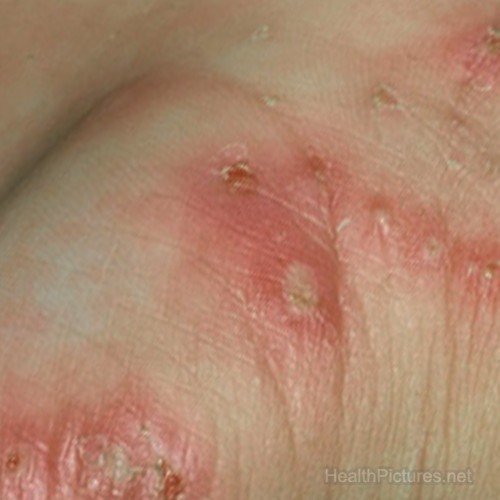 scabies-pictures